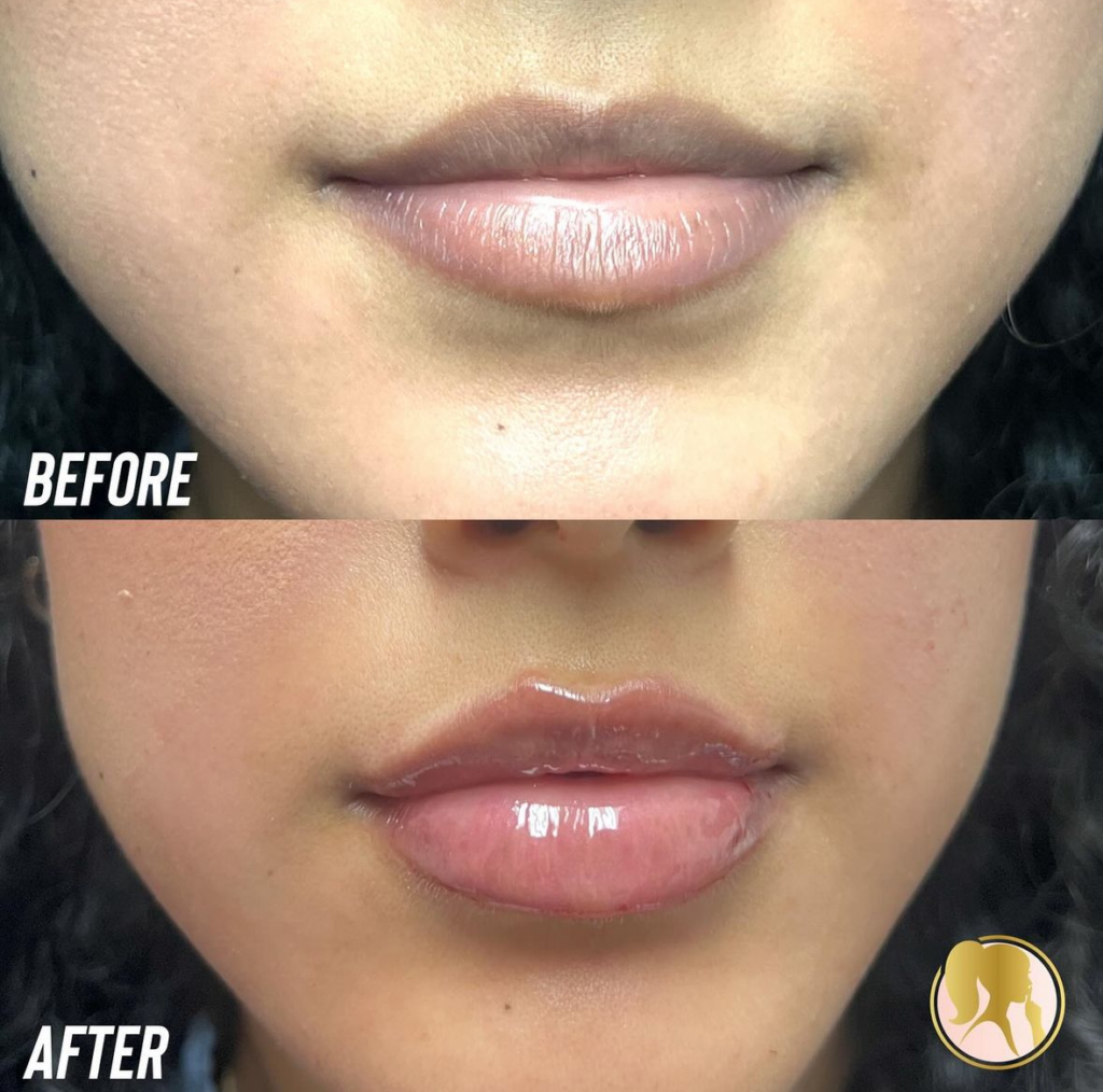 lip injections Los Angeles